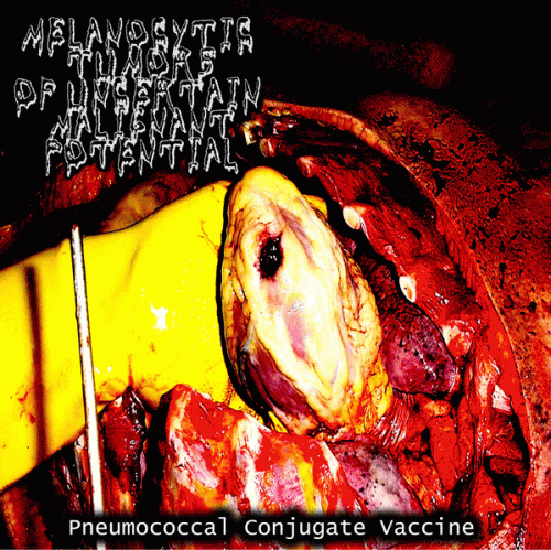 Melanocytic Tumors Of Uncertain Malignant Potential : Pneumococcal Conjugate Vaccine